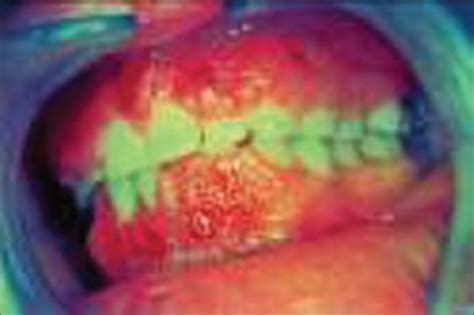 Gingival Hyperplasia In The Left Anterior Region Download Scientific