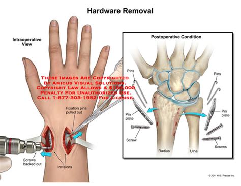 Amicus Illustration Of Amicus Surgery Wrist Hardware Removal Fixation Pins Screws Postoperative