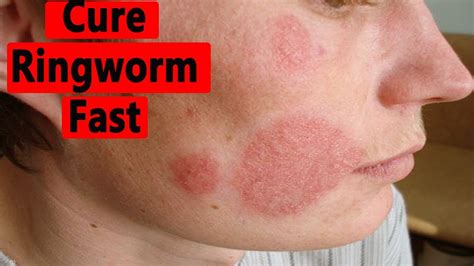 How To Make Easy Natural Remedies To Get Rid Of Ringworm Fast Youtube