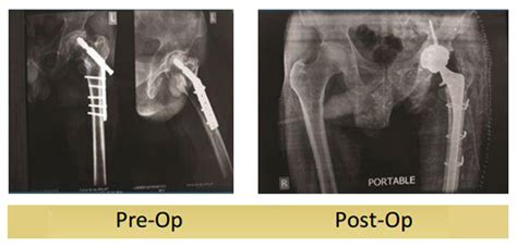 Hip Replacement For Post Traumatic Arthritis Of The Hip