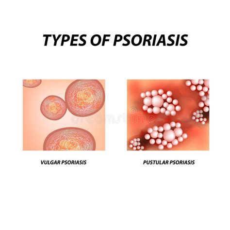 Types Of Psoriasis Not Pustular And Pustular Psoriasis Eczema Skin
