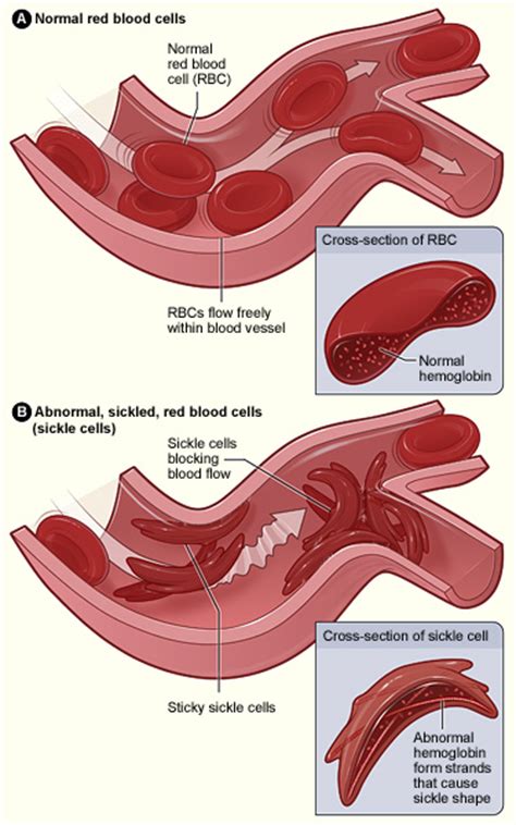 Sickle Cell Anemia Physiopedia