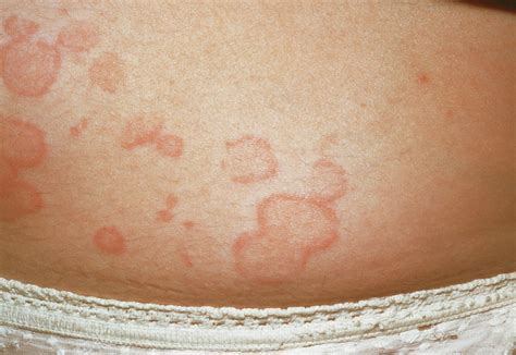 Urticaria Rash On The Skin Photograph By Dr P Marazzi