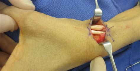 Triggering Of The Abductor Pollicis Longus In Association With