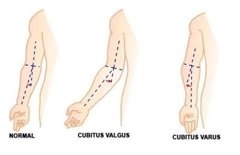Cubitus Valgus Vs Cubitus Varus Medical Education Medical Orthopedics