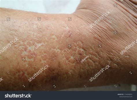 Closeup Eczema Atopic Dermatitis Symptom Infected Stock Photo Edit Now