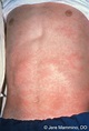 Drug Eruptions - American Osteopathic College of Dermatology (AOCD)