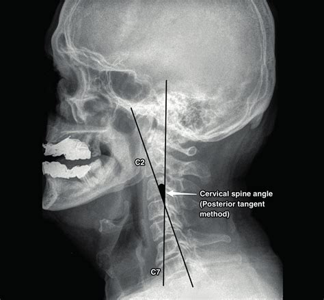 Figure The Measurement Of C2 C7 Total Cervical Lordosis Angle With The