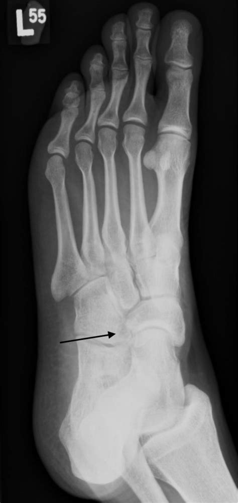 Cubo Navicular Coalition A Rare Cause Of Chronic Foot Pain Eurorad