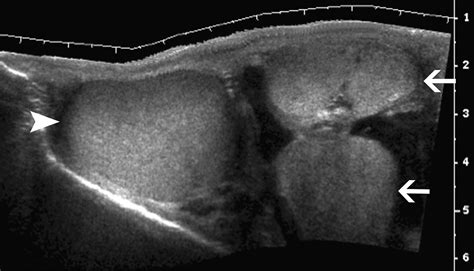 Ultrasonography Evaluation Of Scrotal Masses Radiologic Clinics