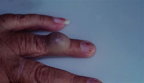 Mucous Cysts Finger Bumps
