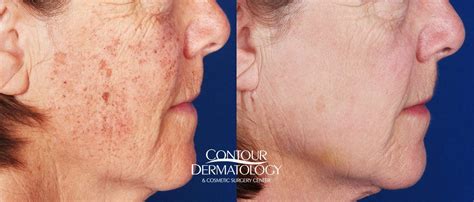Contour Dermatology Ipl Laser Photo Gallery Before And After Palm