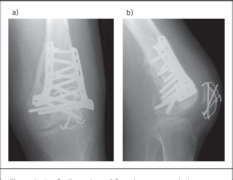 Figure From Surgical Management Of Complex Intra Articular Distal