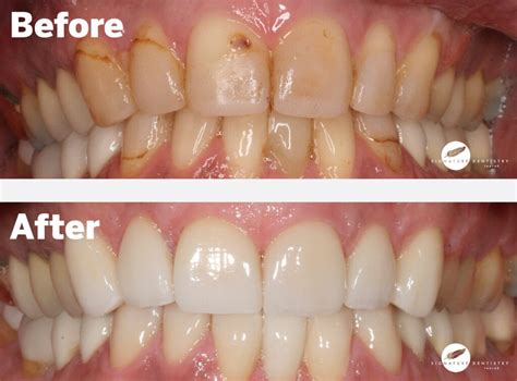 Veneers Before And After By Dr Kasen