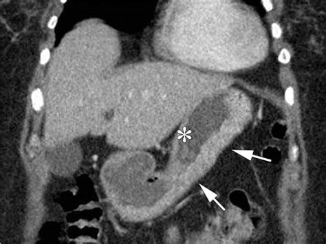 Ligaments And Lymphatic Pathways In Gastric Adenocarcinoma Radiographics