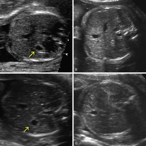 Ultrasound Evaluation Of The Fetal Gastrointestinal Tract And Abdominal