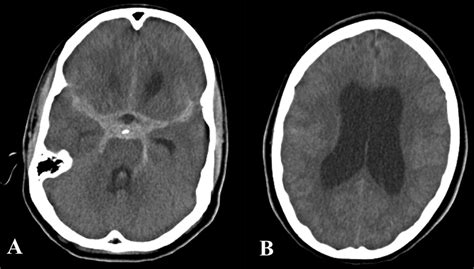 Cerebral Arterial Angioplasty In A Patient With Loeysdietz Syndrome