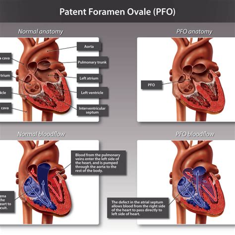 Patent Foramen Ovale Pfo Trialexhibits Inc