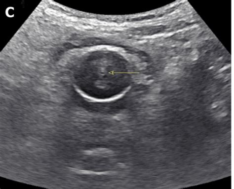 Bladder Ultrasound Made Easy Step By Step Guide Pocus 101