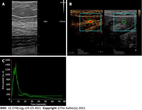 Dynamic Contrast Enhanced Ultrasound In Gastrointestinal Diseases A