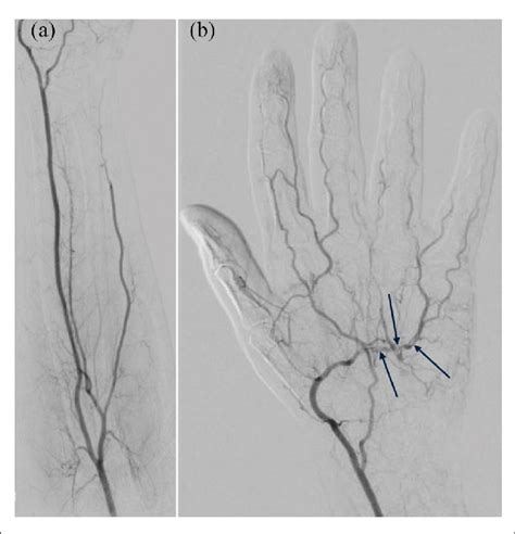 Catheter Angiography Of The Forearm A And Hand B Performed On