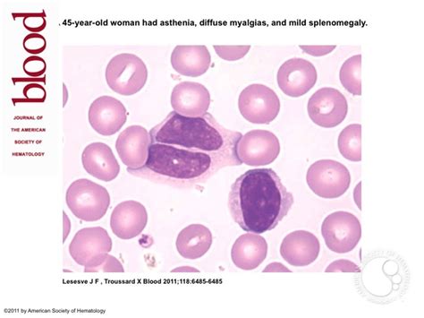 Persistent Polyclonal B Cell Lymphocytosis