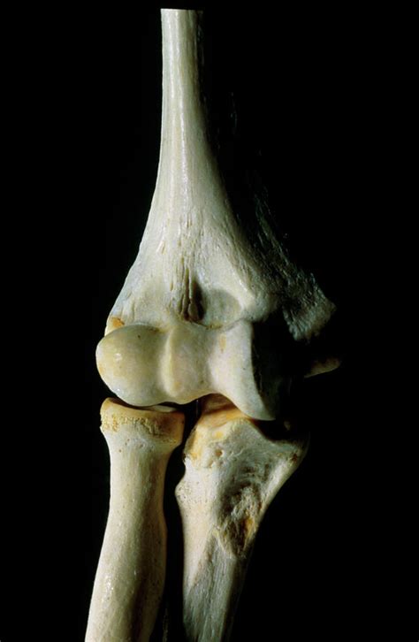 Elbow Joint Photograph By James Stevensonscience Photo Library Pixels