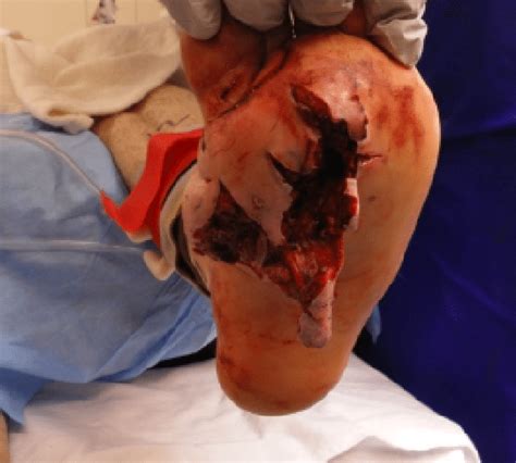 Sunday Gunday 7 Gnarliest Gun Injuries That Will Make You