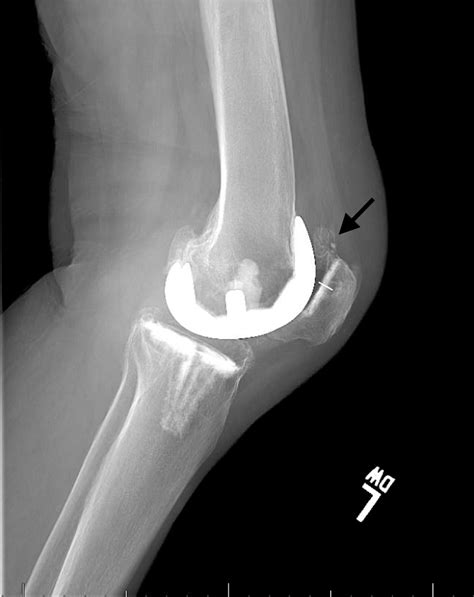 Cureus A Case Report Of Revision Total Knee Arthroplasty After 17