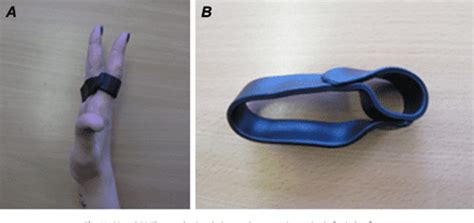 Figure 9 From Relative Motion Orthoses In The Management Of Various