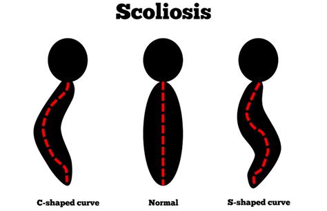 Chiropractic Beneficial For Scoliosis Bridgeport Mi Chiropractor