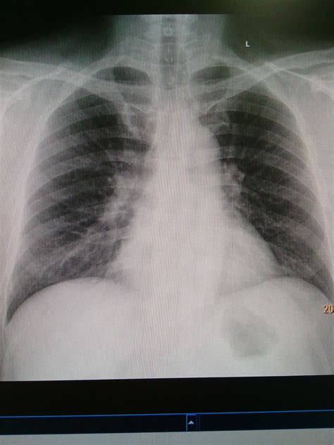 Chest X Ray Bronchitis Radiology Imaging