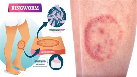 All About Ringworm Causes Symptoms Risk Factors Diagnosis The Best
