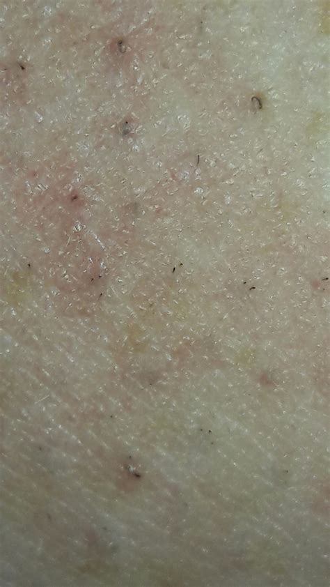 My Angry Ingrown Arm Hairs Popping