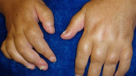 Sausage Fingers Dactylitis Symptoms Treatments And Causes