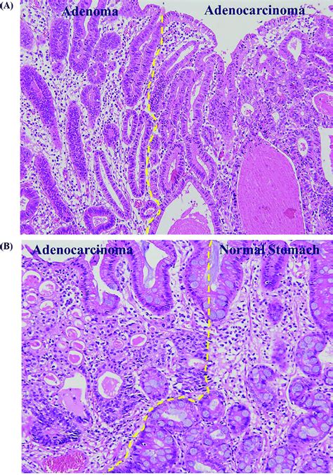 Histopathology Of Early Gastric Cancers With Or Without Pre Existing