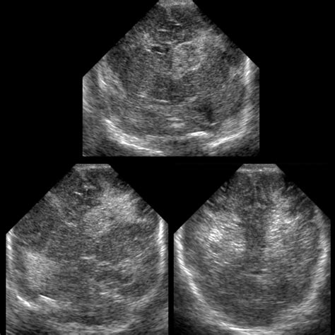 Periventricular Hemorrhage Pediatric Radiology Reference Article