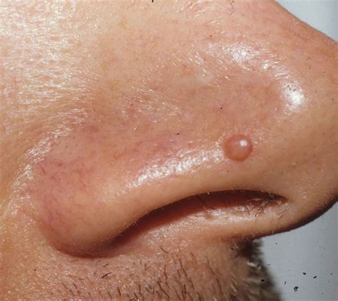 Papule Or Fibrous Papules On Nose Causes Diagnosis Papule Treatment