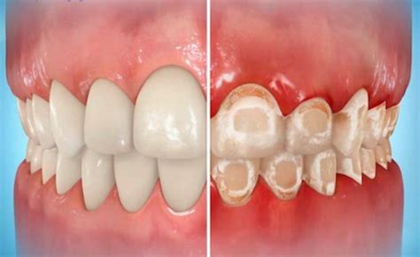 Rinse your mouth as soon as possible to minimize the risk of stains if you drink coffee, tea, red wine, or cola, or eat foods that are likely to stain your white teeth. Proper brushing and flossing with braces on