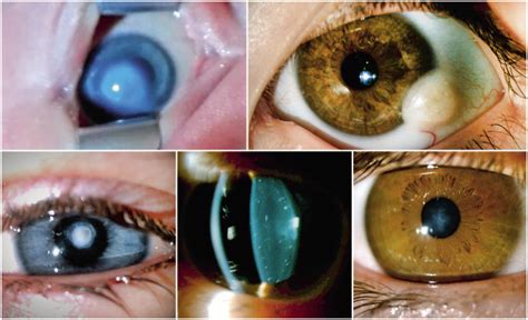 Patología Congénita Ocular Pediatría Integral