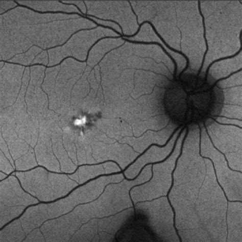 Autofluorescence Imaging Of The Eye Retina Doctor Melbourne