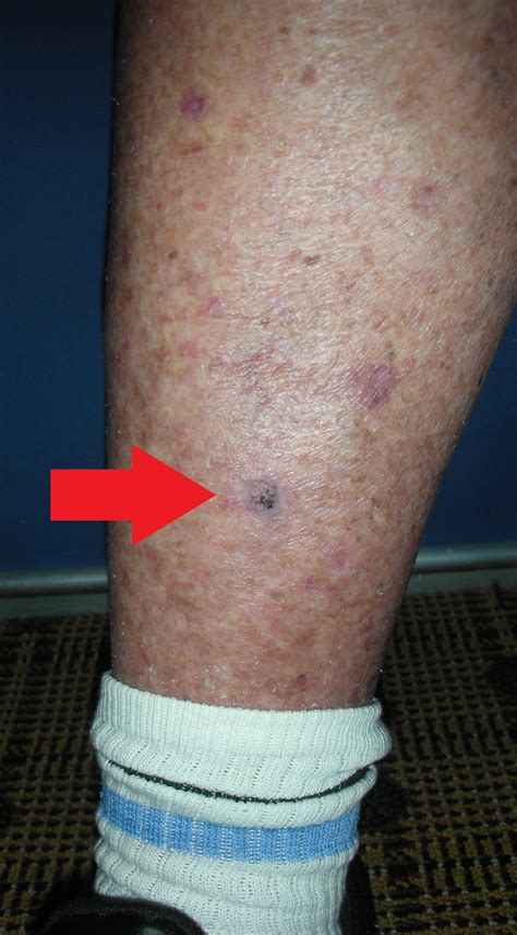Skin Cancer Pictures Leg Idaman
