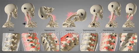 Prolotherapy For Neck Pain And Cervical Instability Caring Medical