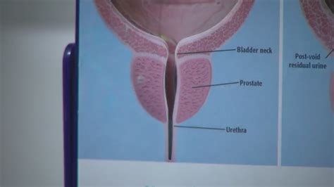 HealthWatch Minimally Invasive Treatment For Enlarged Prostate YouTube