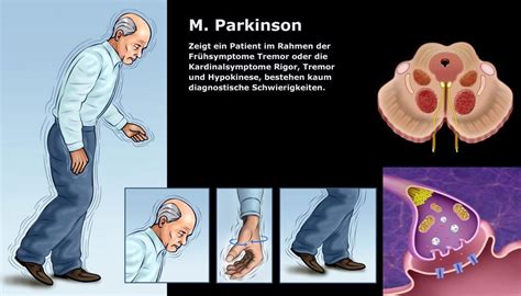 Morbus Parkinson Frühsymptome Und Differentialdiagnostik