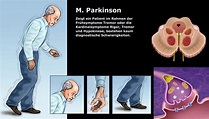 Morbus Parkinson – Frühsymptome und Differential-Diagnostik