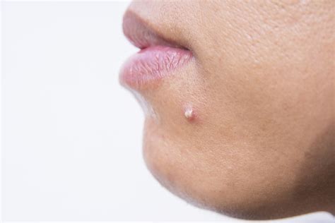 How To Get Rid Of Pimples On The Chin Netgenics
