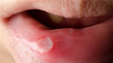 Oral Ulcers In Hiv Patients Vinmec