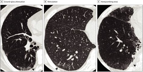 Association of Preexisting Interstitial Lung Abnormalities 