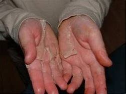 What Causes Peeling In Hands How To Help Med Health Net